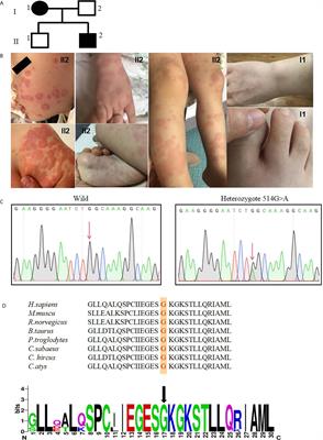 A Novel Mutation in the NBD Domain of NLRC4 Causes Mild Autoinflammation With Recurrent Urticaria